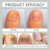 NailDrops 1+1 GRATIS: Flytande Nagelsvamp Reparation Läkning Droppar
