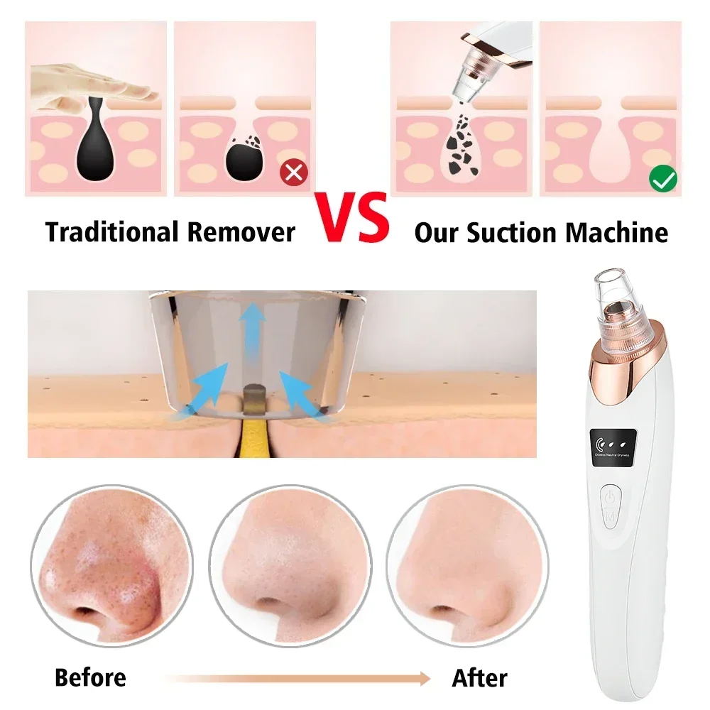 PoreRemover: Uppladdningsbar Smart Blackheads, Whiteheads Pore Avlägsnande Kit
