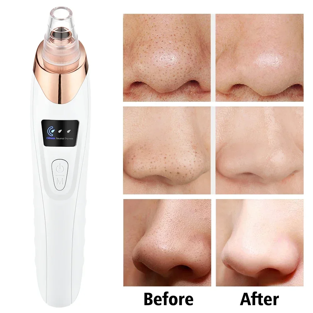 PoreRemover: Uppladdningsbar Smart Blackheads, Whiteheads Pore Avlägsnande Kit